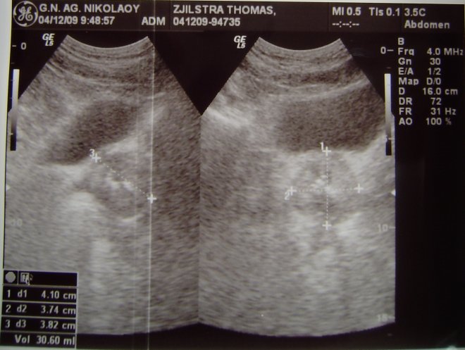 Dit is hem dus. Mijn prostaat. Links dwars en rechts in vooraanzicht. Het is het rondje onder het donkere gebied (dat is de blaas) Linksonder in een tabel de afmetingen