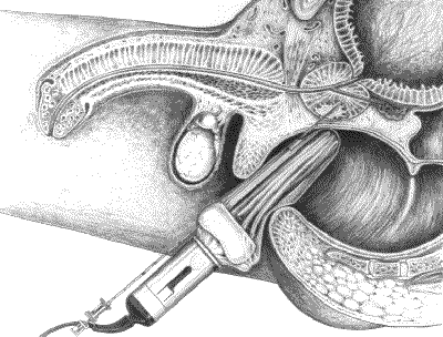 Echografie van de prostaat met biopsie. Folder MST