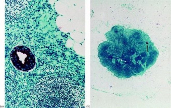 Een micrometastase van een prostaatcarcinoom in een lymfeklier . Rechts de klier met de micrometastase bij de zwarte pijl, links een vergroting. De metastase toont de typische klierbuisachtige structuur van het adenocarcinoom van de prostaat