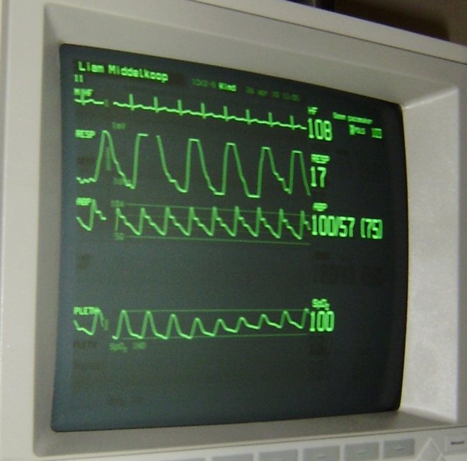 Een van de monitoren bij Liam. Van boven naar onder ECG en hartslag, ademhaling, bloeddruk en zuurtsofverzadiging. Alles in orde