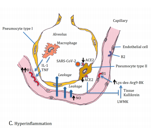 Een longblaasje (alveolus) met een bloedvaatje eromheen, Een pneumocyt (longcel) in de alveolus krijgt juist een infectie van het SARS-virus via de ACE2-receptoren (bron: besproken artikel)