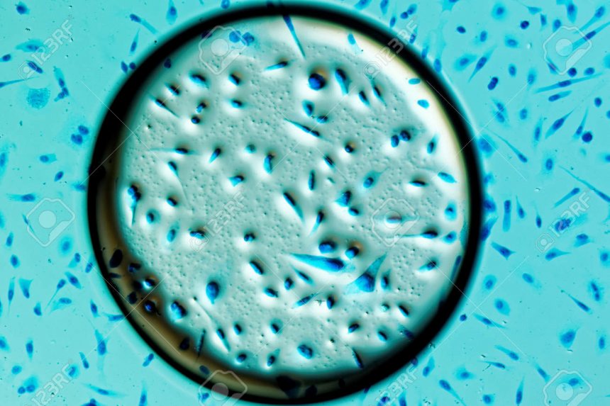 Menselijke prostaatkankercellen in luchtbel, gekleurd met Coomassie blauw, onder differentiële interferentie contrast microscoop.